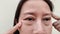 The Flabbiness skin, cellulite and bag under the eyes, wrinkles and ptosis beside the eyelid, forehead lines on the face