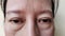 The Flabby wrinkle and freckles, dark spots and ptosis beside the eyelid