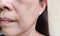 The Flabby and wrinkle beside the mouth, problem blemishes and dark spots on the face.