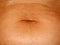 Flabby wrinkled abdomen. The navel is stretched.