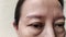 The Flabby wrinkles and ptosis beside the eyelid