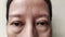 The Flabby wrinkles and ptosis beside the eyelid