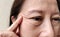 The Flabby wrinkles and ptosis beside the eyelid