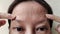 The Flabby wrinkles and ptosis beside the eyelid