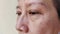 The Flabby wrinkles and ptosis beside the eyelid
