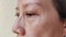 The Flabby wrinkles and ptosis beside the eyelid