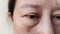 The Flabby wrinkles and ptosis beside the eyelid
