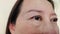 The Flabby wrinkles and ptosis beside the eyelid