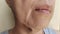 The Flabby wrinkles and ptosis beside the mouth