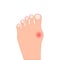 Flat foot disease color icon