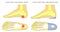 Flat foot with orthopedic insole_Heel pain relief pad