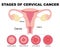 Flat illustration of cervical cancer stages. Diseases of the female reproductive system.Cervical canal, cervix, vagina. Carcinoma,