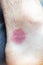 Flea bite closeup chest arm foot skin, bitten insects bug