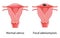 Focal Adenomyosis Human anatomy Female reproductive system diagram with text Sick and normal organ uterus vagina icon