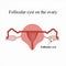 Follicular ovarian cyst. Functional . Infographics. Vector illustration