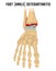 Foot arthritis image