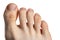 Foot of caucasian man with skin diseases. Callus corn and rare nevus