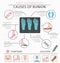 Foot deformation as medical desease infographic. Causes of bunion