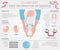 Foot deformation, medical desease infographic. Clubfoot defect