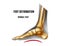 Foot deformation. Normal arch bones skeleton realistic anatomy illustration