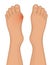 Foot disease