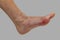 Foot disease Rheumatism and gout. Red leg swelling. Pain in the foot