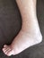 Foot of diseased female patient who suffers from edema illness