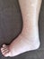 Foot of diseased female patient who suffers from edema illness