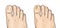 Foot fungal infections. Athlete`s foot is a fungal infection