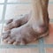Foot of gout patient