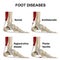 Foot joint, normal foot and diseases. Plantar fasciitis, achillobursitis, Haglund-shinz disease