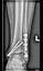 Foot medical xray, lower limb bones, broken ankle, tibia fibula with screws