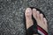 A foot with mild athlete`s foot eczema on toes. Unkempt and uncut toenails