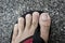 A foot with mild athlete`s foot eczema on toes. Unkempt and uncut toenails