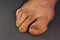 Foot Nail fungus, damaged toenails due to improper shoes. Protruding joint. Unfocused male foot