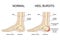 Foot with normal heel and foot with Haglund\\\'s deformity and bursitis.