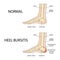 Foot with normal heel and foot with Haglund\\\'s deformity and bursitis.