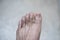 Foot of pateint skin dermatitis