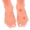 Foot with pathologies. Fungal lesions of the foot, nails and skin. Athlete`s foot, candidiasis, omnios. dermatitis. Dermatology ve