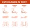 Foot pathologies infographic. Flat foot anatomy. Deformed