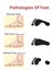 Foot pathologies, Normal, flat and hollow foot - Vector Illustration