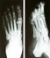 Foot radiography