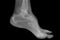 Foot radiography of a hospital patient
