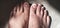 foot skin desease in adult men in asia