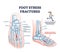 Foot stress fractures as bone cracking trauma or injury outline diagram