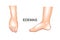 Foot swelling. edema