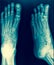 Foot and toes injury x-ray scan orthopedics and Traumatology rad