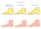 Foot types