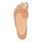 Foot wart. Foot bottom pathology: verruca, wart, papilloma virus.