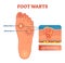 Foot warts vector illustration. Scheme with solitary and mosaic warts. Close-up with wart and its supply of blood and nerves.